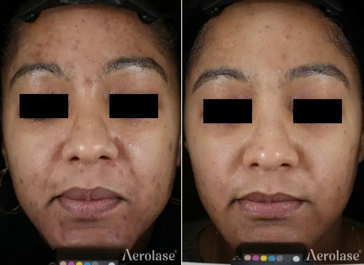 Aerolase Neo Elite - Acne