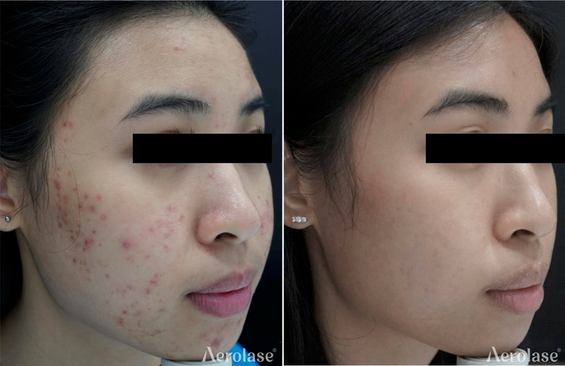 Aerolase Neo Elite - Acne