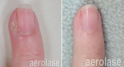 Aerolase Neo Elite - Wart Removal