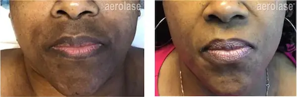 Aerolase Neo Elite - Melasma