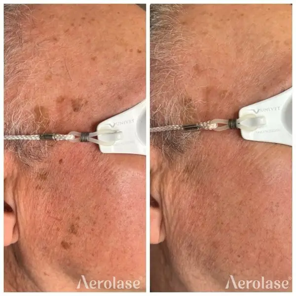 Aerolas Neo Elite - Pigmentation