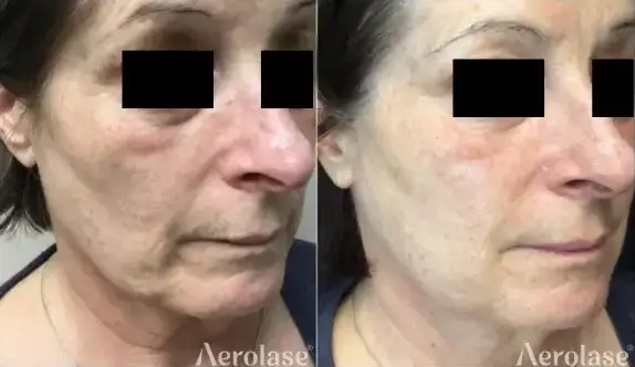 Aerolase Neo Elite - Skin Rejuvenation